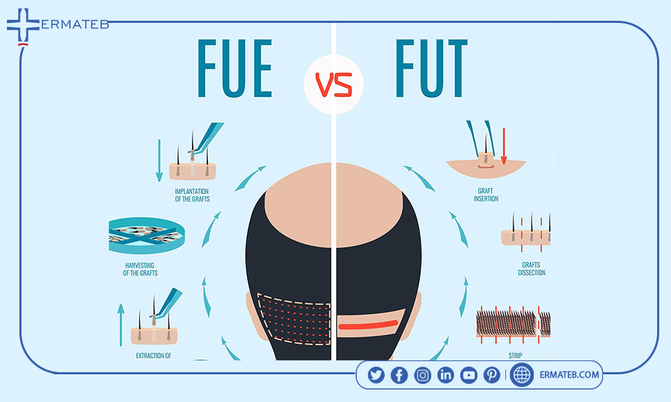 fut vs fue
